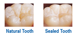 all-about-dental-sealants